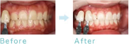 ポリリンコーティング前と後の歯の写真