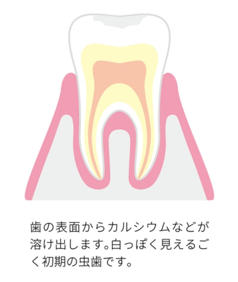 初期の虫歯の断面図。歯の表面からカルシウムが溶け出し、白く見える状態を示している。