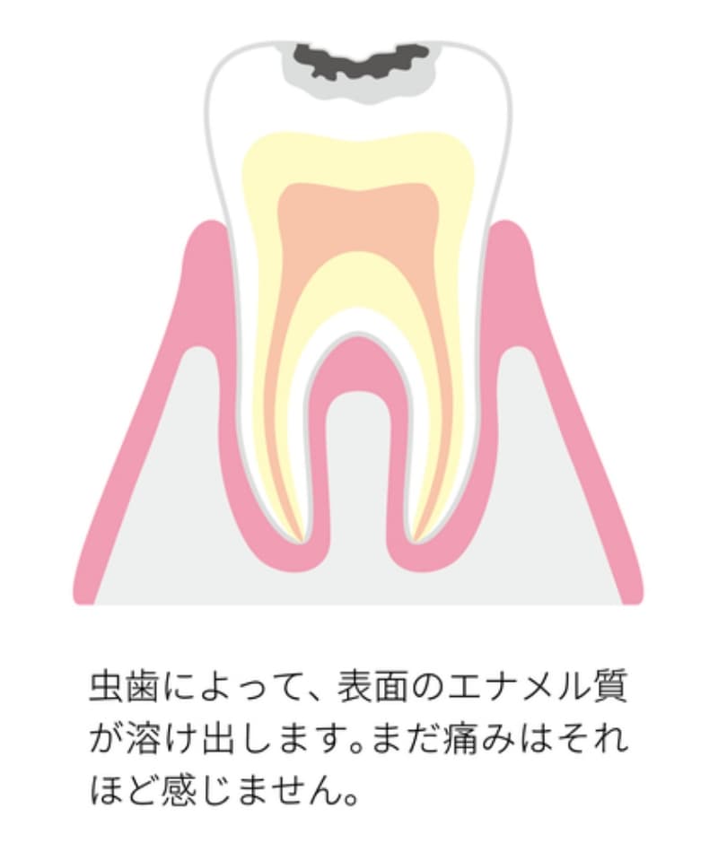 エナメル質が虫歯により溶け出した歯の断面図。まだ痛みはほとんど感じない初期の虫歯の状態。