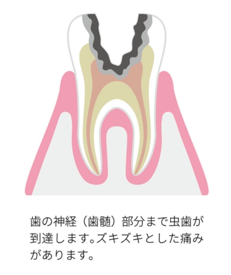 虫歯が歯髄（神経）にまで進行した歯の断面図。ズキズキとした強い痛みを伴う状態。