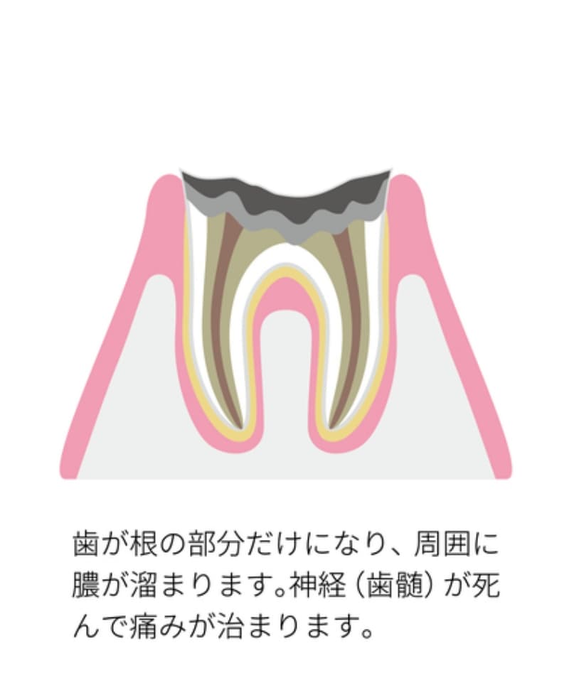 虫歯が進行して歯の根だけが残り、神経が死んで膿が溜まった歯の断面図。痛みは一時的に治まっている状態。
